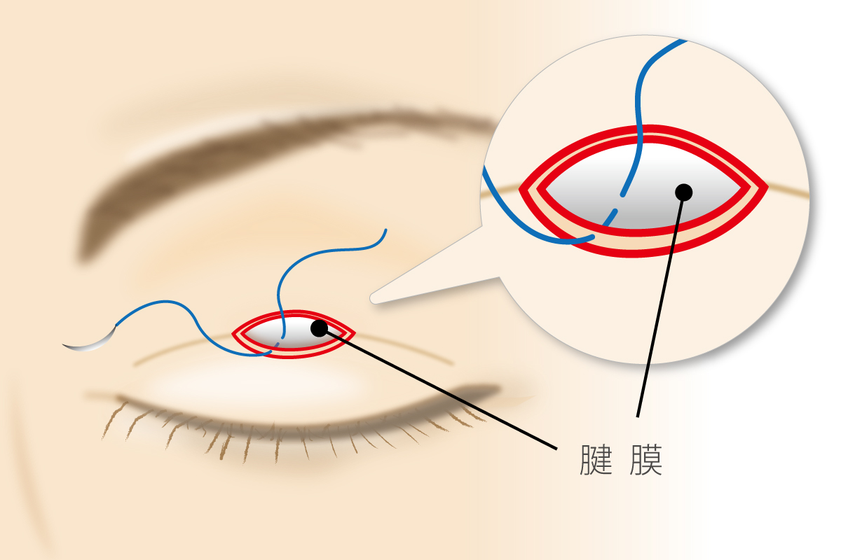 重瞼術 (小切開法）手順3