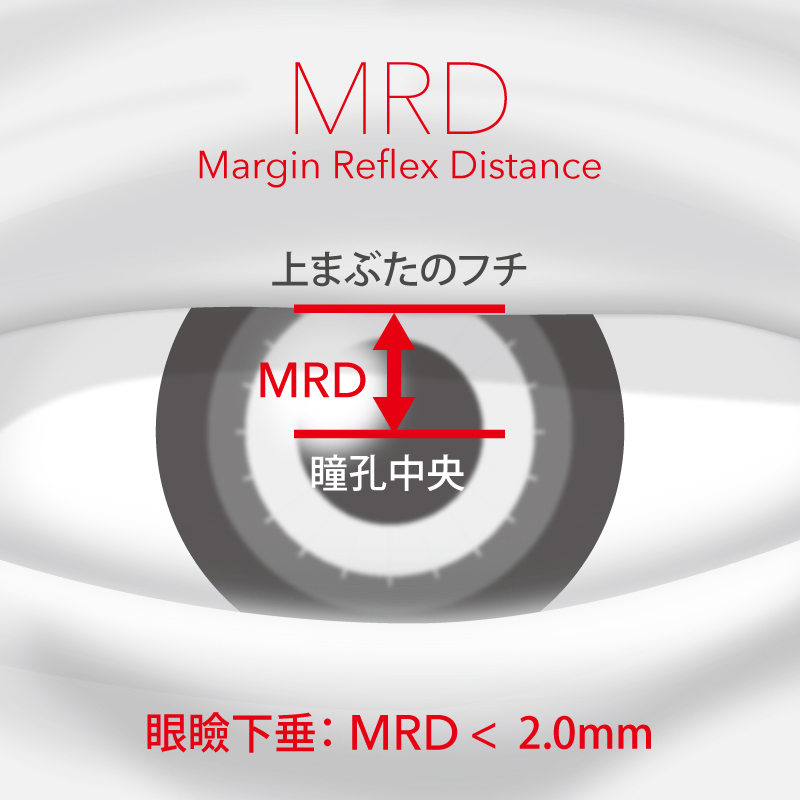 MRD（Margin Reflex Distance: 瞼縁角膜反射距離）