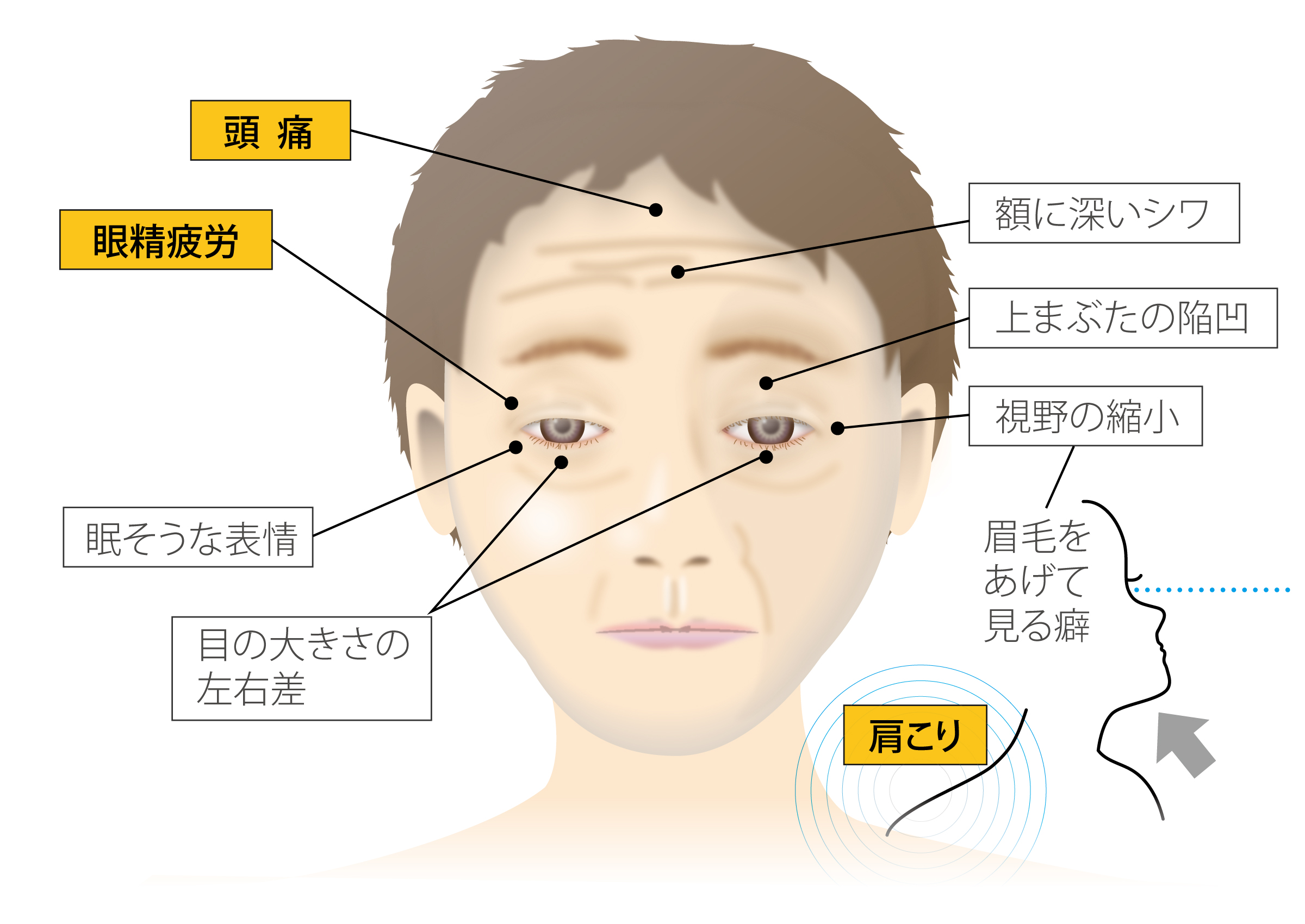 眼瞼下垂の症状の一例